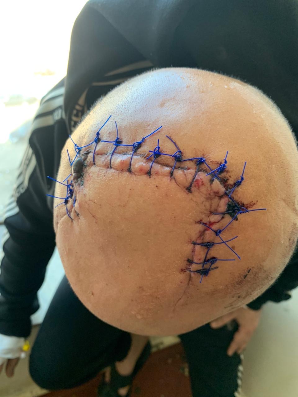 مشاجرة دامية في بولاق الدكرور.. كسر بالجمجمة وإصابات بالجملة في خناقة بين أصحاب ورش كاوتش